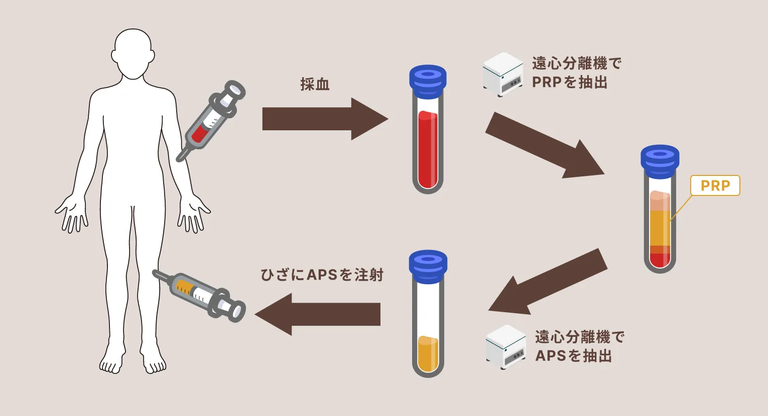 APS治療の工程