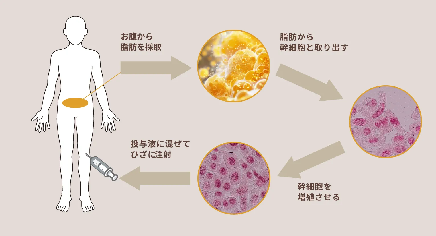 培養幹細胞治療の工程