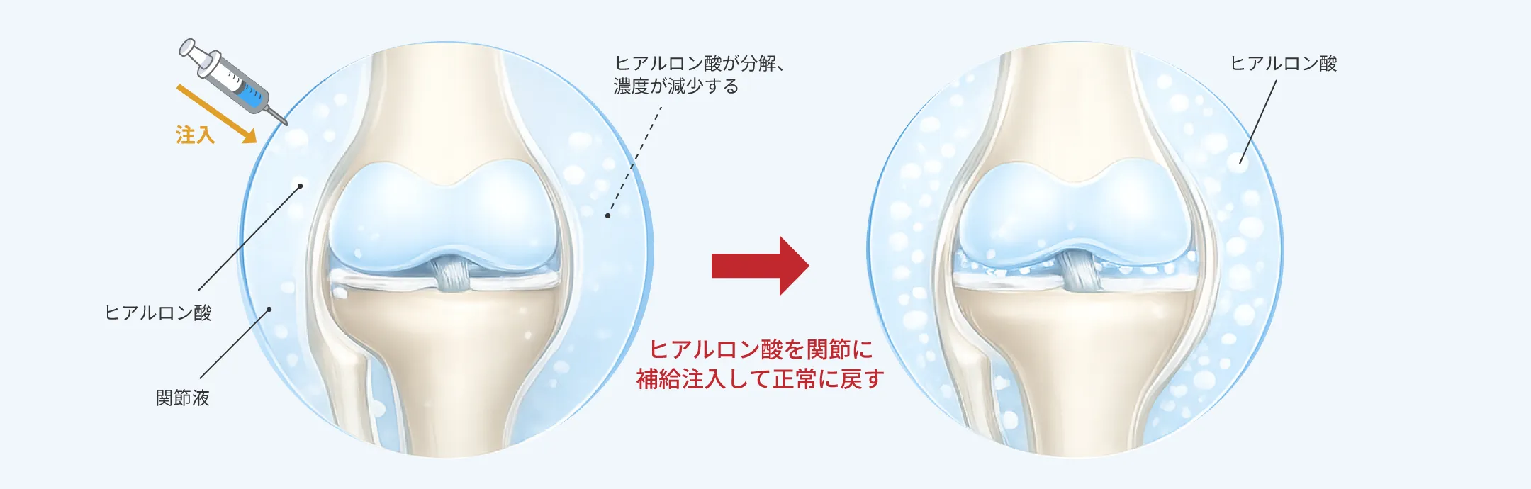 ヒアルロン酸注射の作用機序