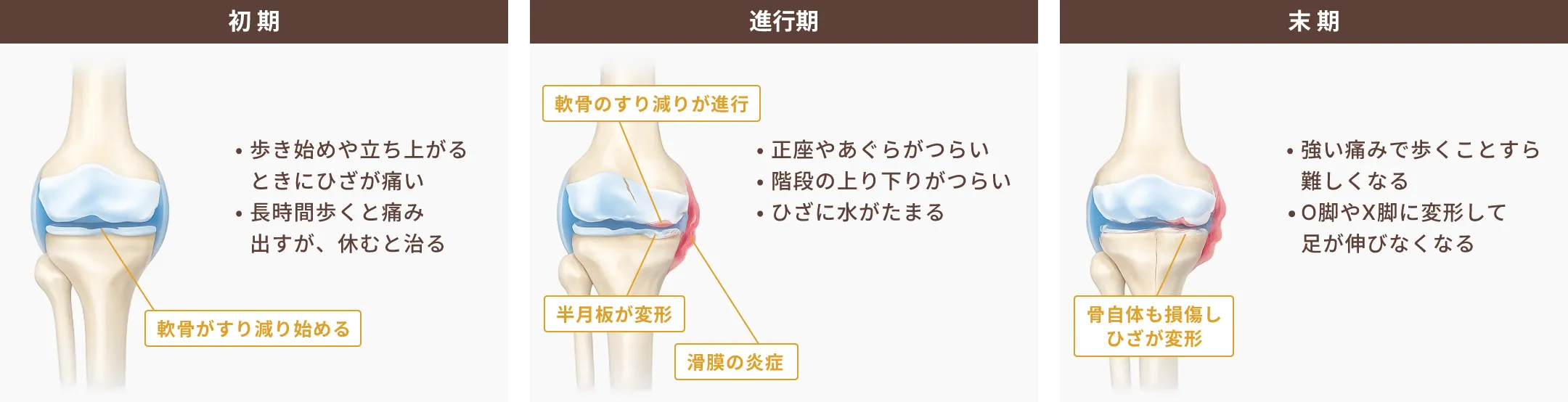 変形性膝関節症の病態と症状