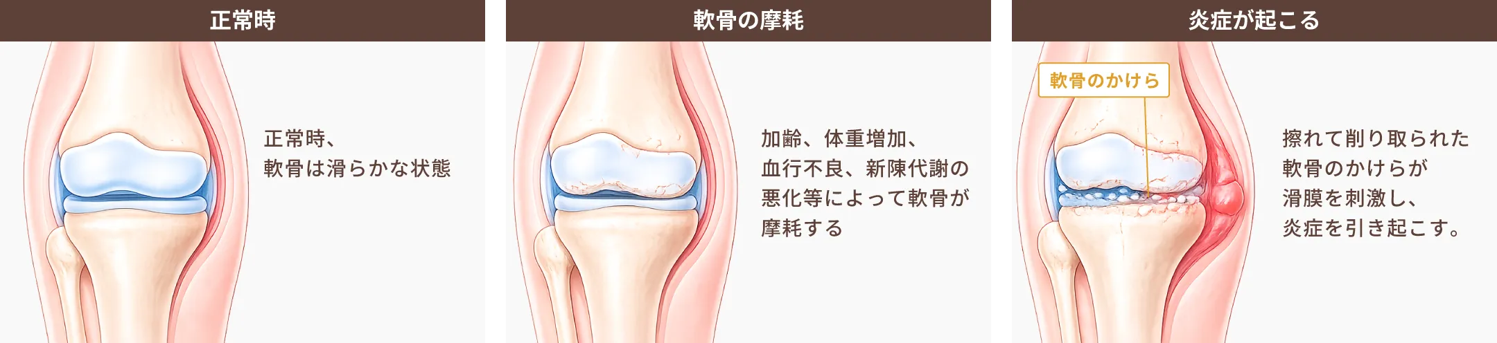 炎症が起こるしくみ
