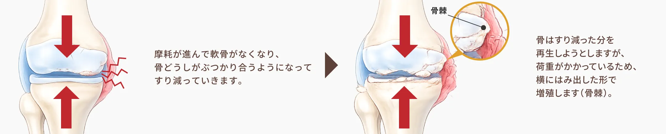 骨棘形成のプロセス