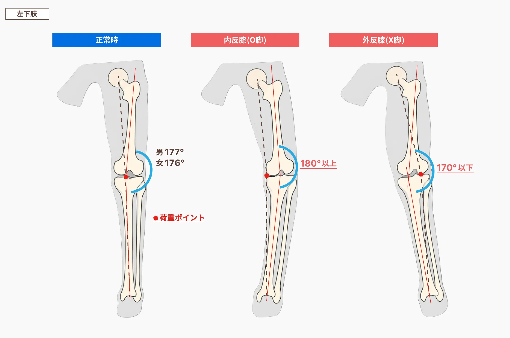 変形性膝関節症の症例図