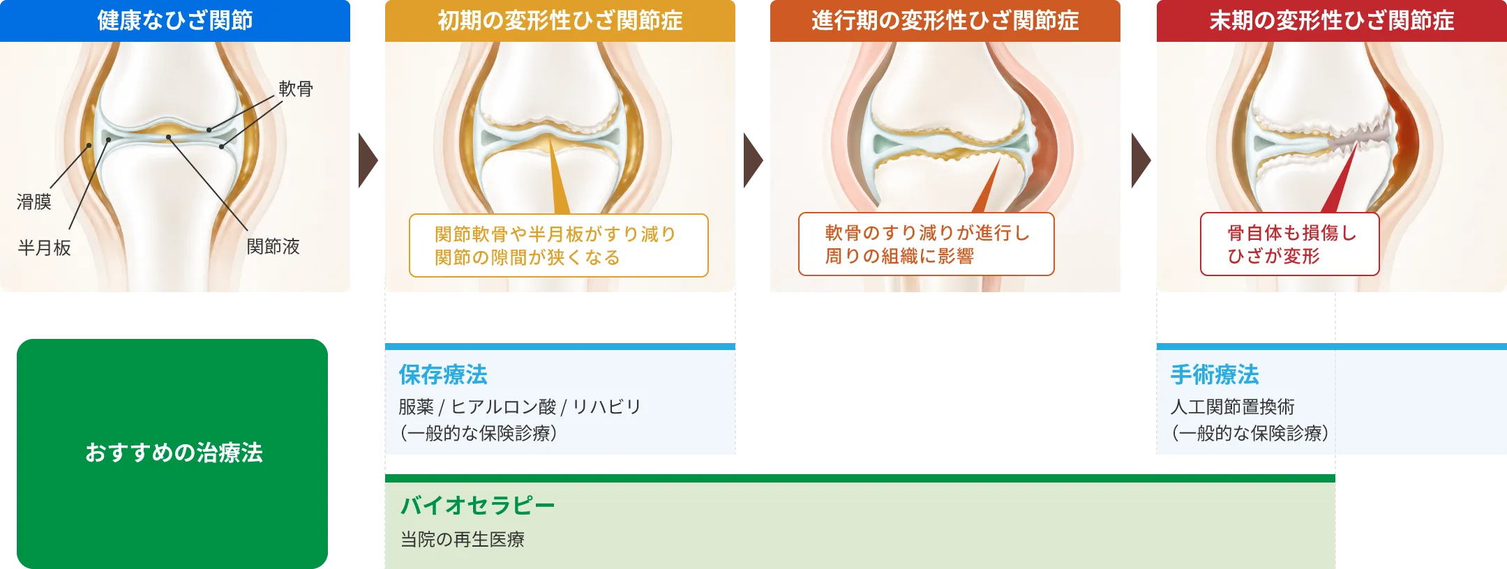 変形性膝関節症の進行とそれに準じた治療法