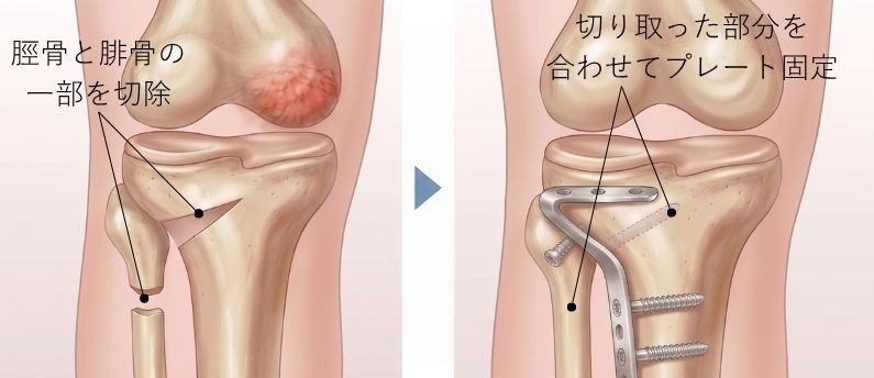 クローズドウェッジ法のイラスト図