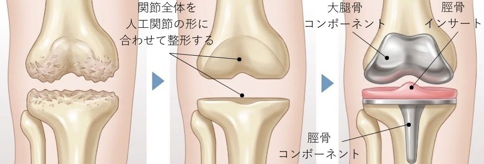 全置換術（TKA）のイラスト図