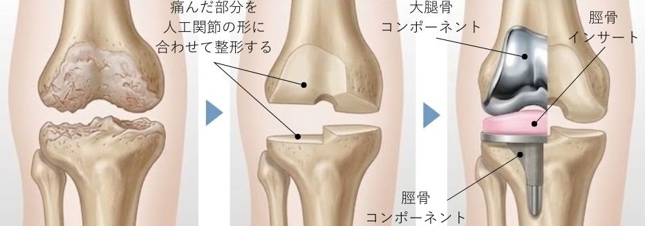 単顆換術（UKA）のイラスト図