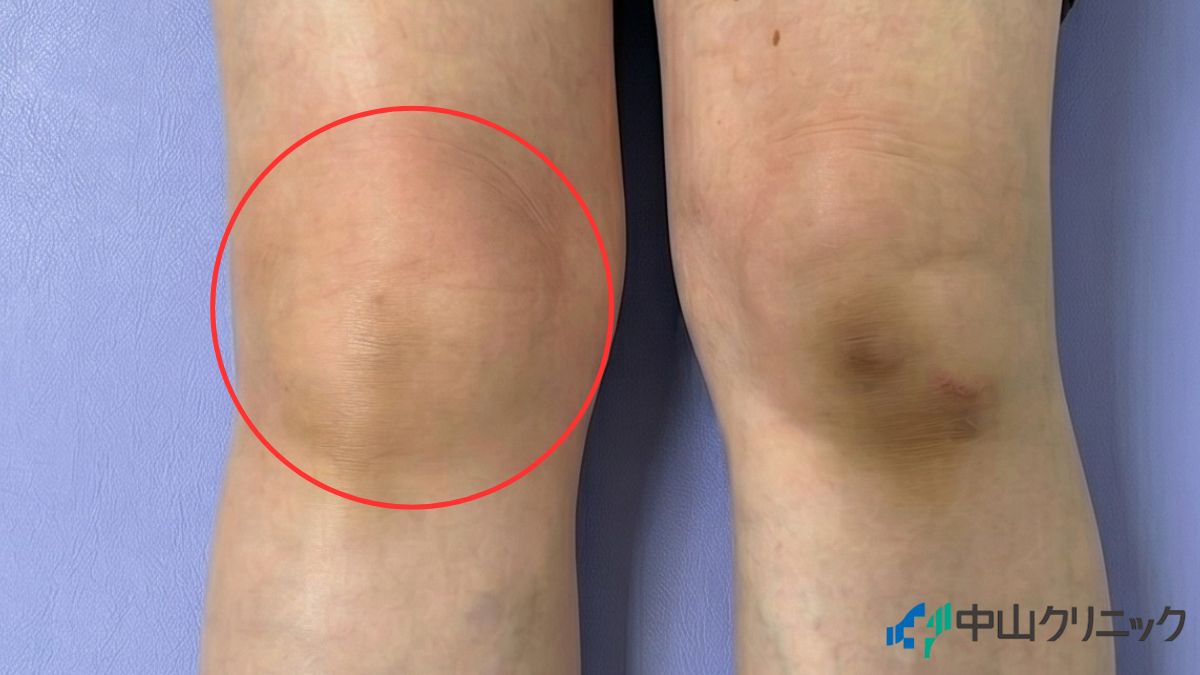 膝に水がたまって腫れている右膝の症例写真