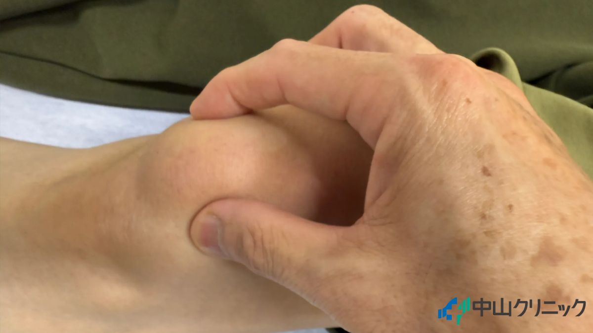 膝に水が溜まり腫れている右膝の症例写真