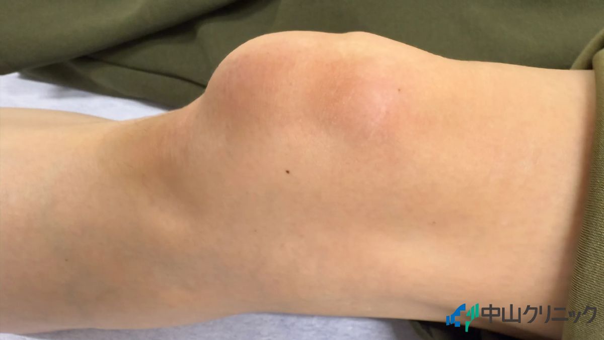 膝に水が溜まり腫れている右膝の症例写真