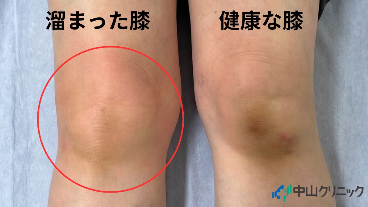 健康な膝と水が溜まった膝の比較写真